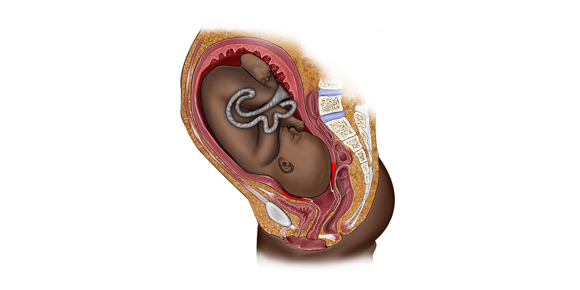 Black fetus in womb