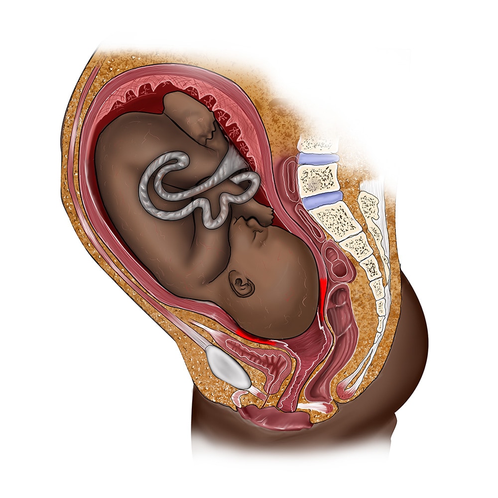 Black fetus in womb